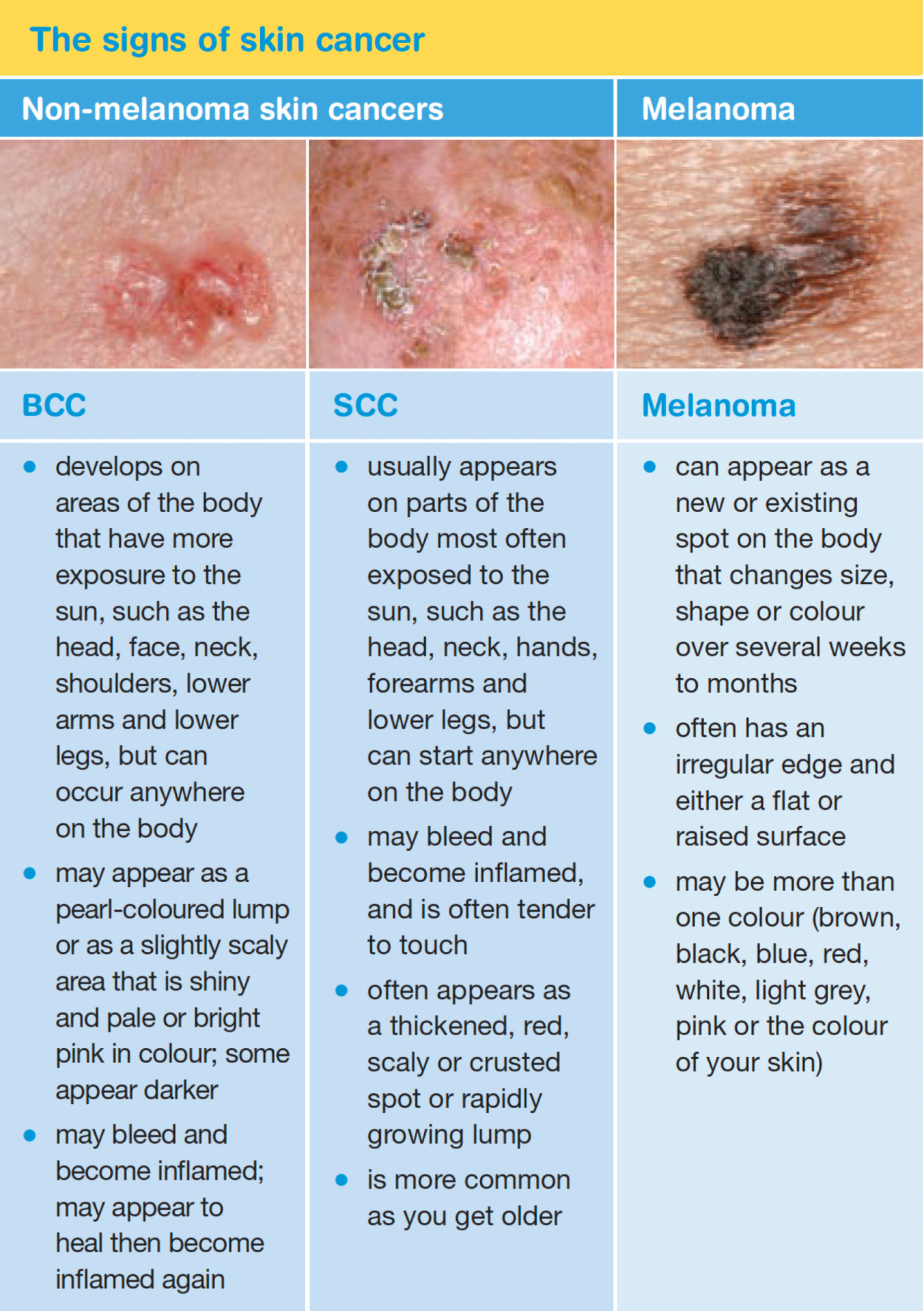 Types Of Skin Cancer Can You Spot Them CLOUD HOT GIRL